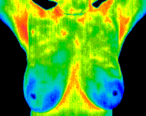 breast1