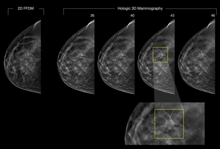 Mammogram vs. Thermogram vs. Other – Thermography Advantage