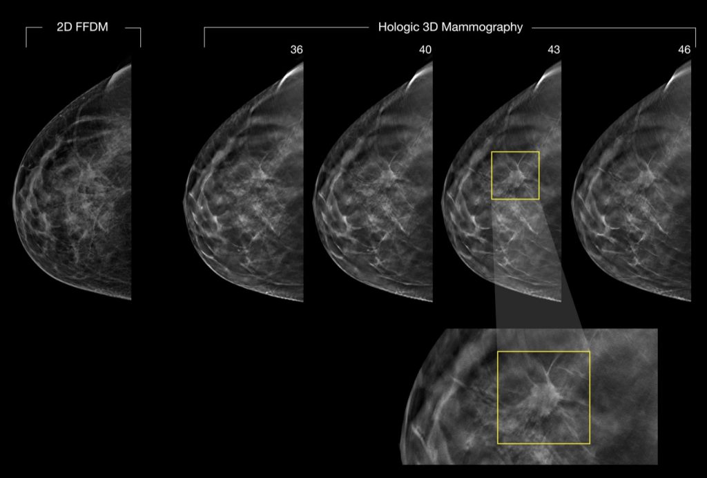 CaseStudy_2D-vs-3D-digital-CancerDiagnosed-copy-1024x692