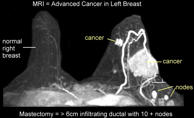 Mammogram Vs. Breast MRI What s the Difference Intercoastal