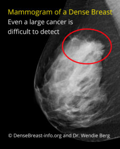 What Does It Mean to Have Dense Breasts? - Thermography